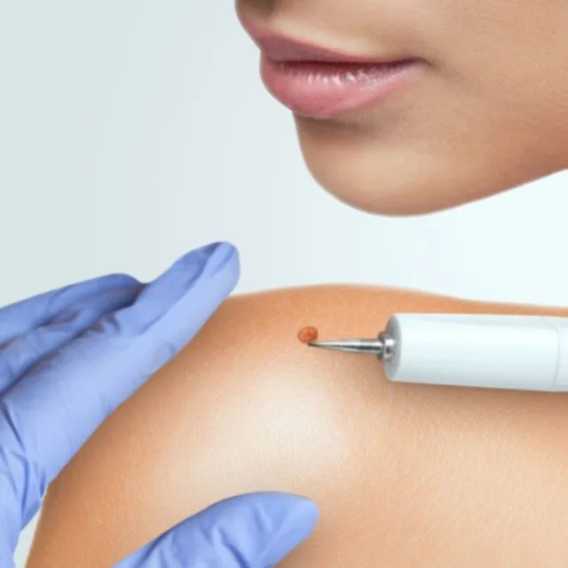 Laserbehandlung zur Entfernung eines Muttermals 